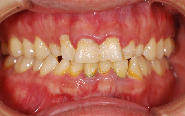 が 奥 の 腫れる 歯茎 奥歯の奥の歯茎あたりが腫れて少し痛みがあります。