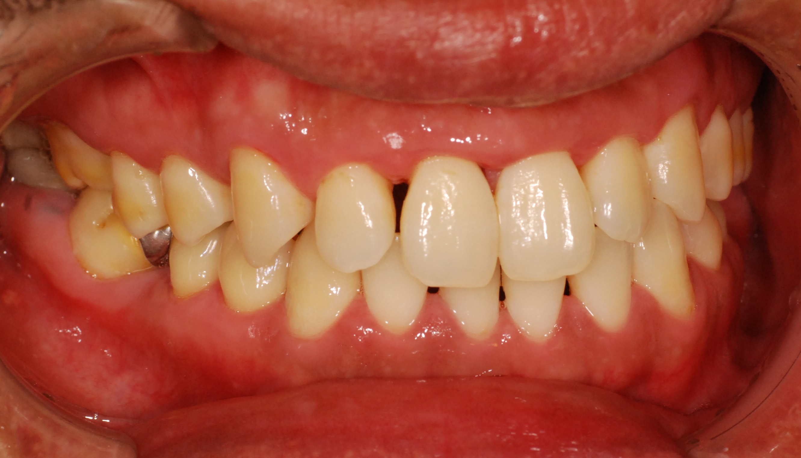 膿 歯茎 歯茎に膿が出たらすぐに歯医者に行く理由。歯の健康を保つことは究極の節約です