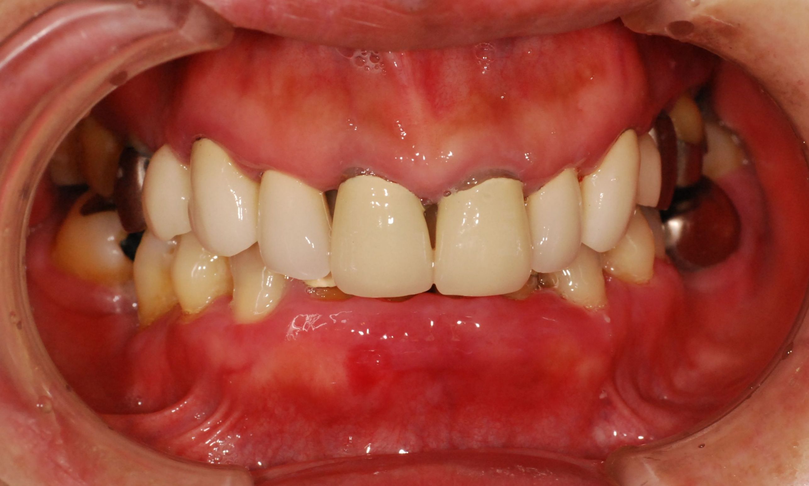 腫れ 歯茎 の なかなか治らない歯茎・歯肉の腫れ（根管の炎症と歯周病）